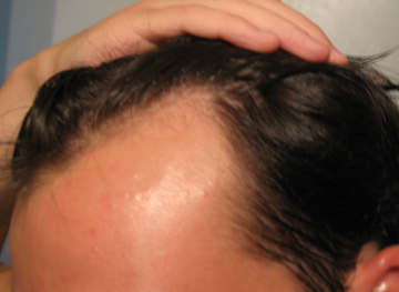 25 Receding Hairline Minoxidil Hairlosstalk Forums