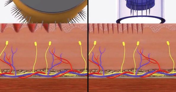 roller_vs_needling.jpg