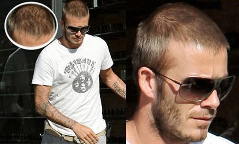 rsz_david_beckham_hair_loss-1.jpg