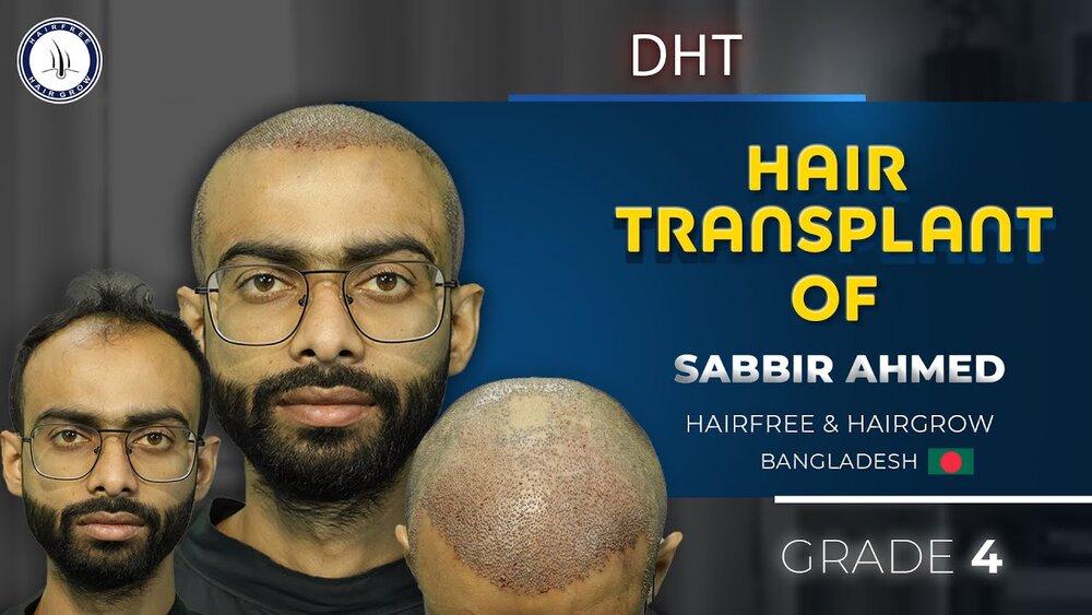 Sabbir Ahmed’s Hair Restoration Journey.jpg