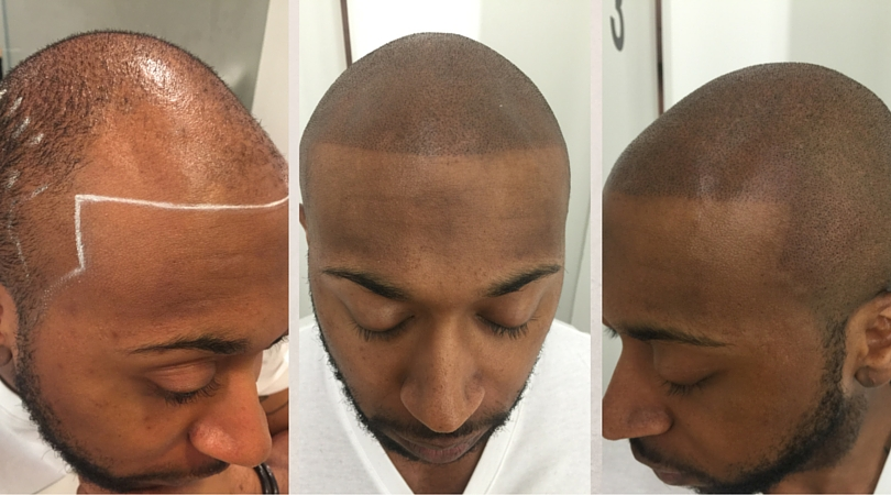 scalp-micropigmentation.png