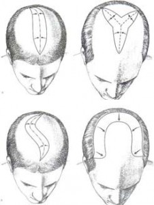 scalp-reduction-surgery-226x300.jpg