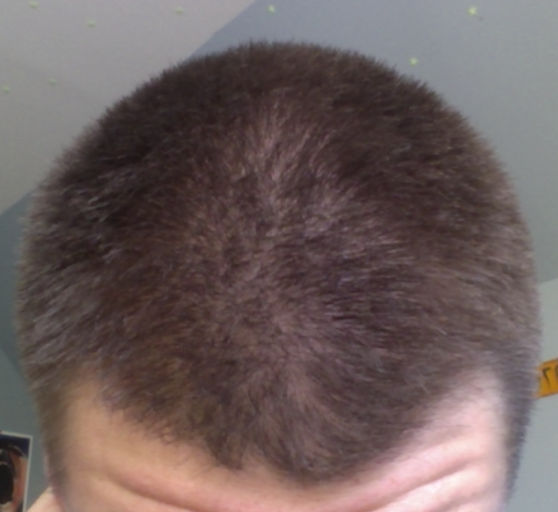 Am I Balding At 19 Or Is This Normal? | HairLossTalk Forums