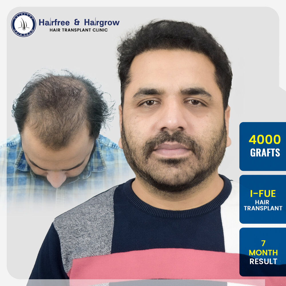 shrinivas-katekar-4000-grafts-i-fue-hair-transplant-7-month-result-pune.jpg.jpg