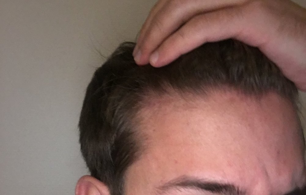 Is This Early Stages Of Male Pattern Baldness HairLossTalk Forums