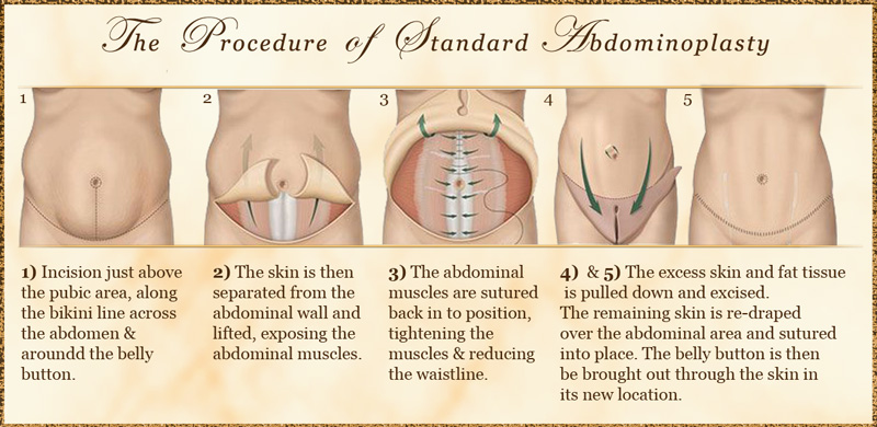 standard-Abdominoplasty1.jpg