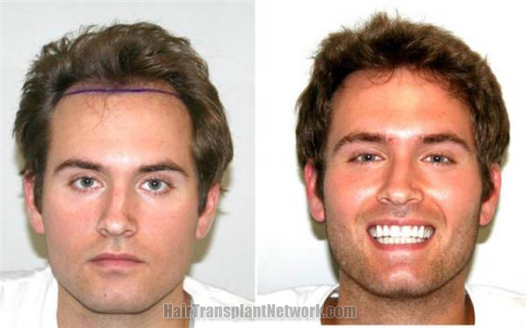 surgical-hair-transplantation-front-160760.jpg