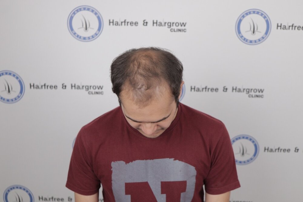 Susmit Gogate before hair transplant.JPG