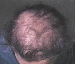 thyroid-hair-loss.jpg