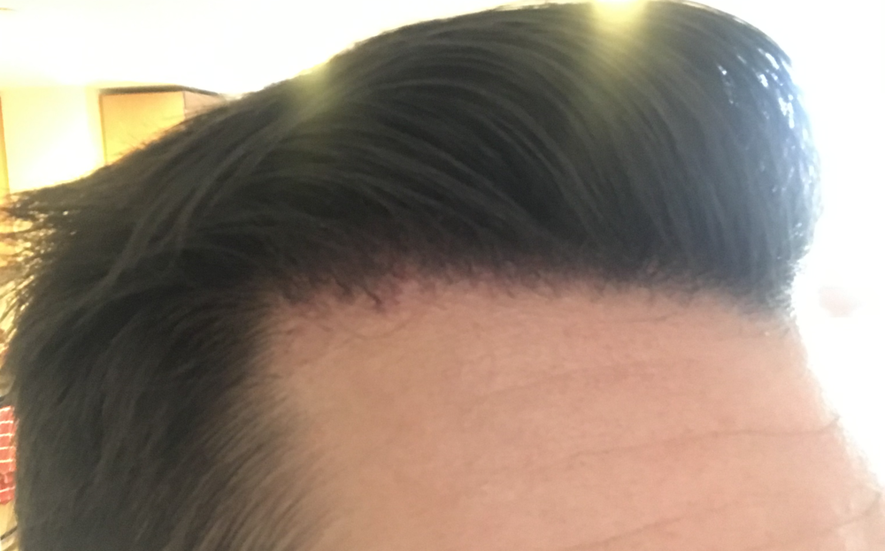 TP3 right side 2.5 months.png