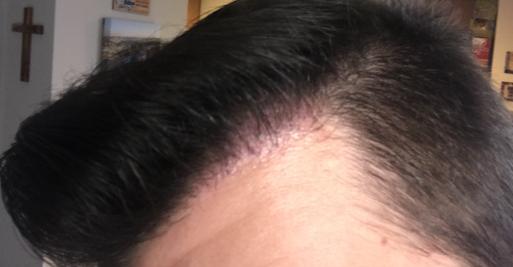 TP3_left side 2.5months.png