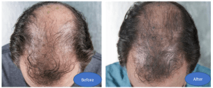 Triple-Hair-3-month-TH16-before-after-hair.png