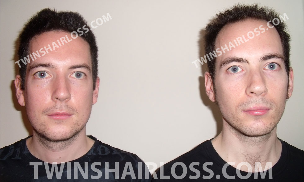 twins-hair-loss-comparison-photo-11.jpg