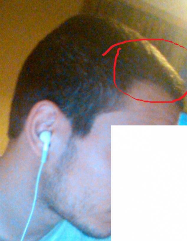 Nizoral And My Hair Loss Pics Provided Hairlosstalk Forums