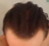 HairLossTalk.com 049.jpg