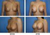 breast-augmentation-surgery.jpg