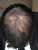 22nd-Feb-2014---2-and-a-half-months-of-finasteride,-minoxidil-w-aa-and-nizoral.jpg