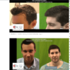 hairline lowering.PNG