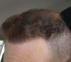 9 mesi hair transplant  (2).jpg