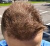 9 mesi hair transplant  (4).jpg