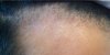 right temple 4,5 months finasteride, 2 months minoxidil.jpg