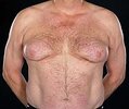 200px-Severe_bicalutamide-induced_gynecomastia.jpg