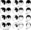 Partial_Norwood_scale_for_male_pattern_baldness.png