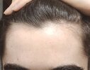 Hairline (Today).jpg