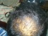 1 month finasteride with Min.jpg