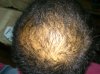 3 month finasteride and Min.jpg