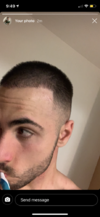 3-4 months into finasteride 1mg and minoxidil 5% rogaine (1).PNG
