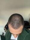 5 or 6 months ago where i noticed drastic decrease in density and hairline minaturising causin...JPG