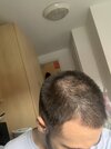 september 2019 prior to finasteride  (2).JPG