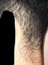 InkedTEMPLE2- 9 MONTHS ON MINOXIDIL_LI.jpg