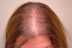 androgeneticheskaya-alopeciya_s.jpg