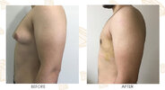 diamonds-jinekomasti-en-gynecomastia-surgery-before-after-02.jpg