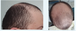 Screenshot 2024-12-31 at 16-53-03 Vitamin D Deficiency and Hair Loss A Case Report and Review ...png