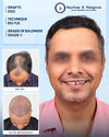 4165-grafts-big-fue-hair-transplant-grade-5-pune (1).jpg