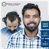 dadasaheb-tadwalkar-2800-grafts-i-fue-hair-transplant-10-month-result-pune-india.jpg-200kb.jpg