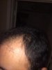 left Hairline after.jpg