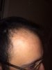 Right hairline-after.jpg