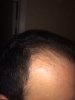 hairline after.jpg