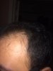 hairline after left.jpg