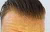 frontal regrowth.jpg