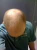 BALDING 3.jpg