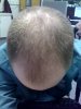 BALDING 2 MONTH.jpg