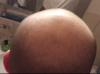 hairloss.PNG