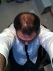 hair loss 2.JPG