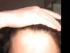 11 weeks finasteride(4).jpg