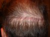 hair transplant #3-SCAR.jpg